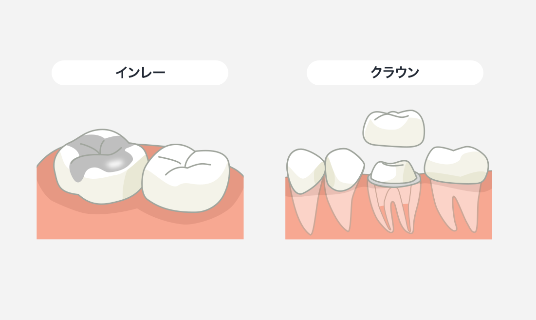歯の修復