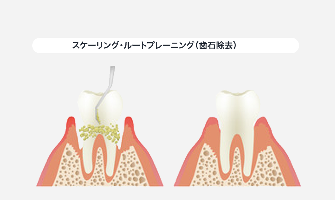 歯茎のメンテナンス